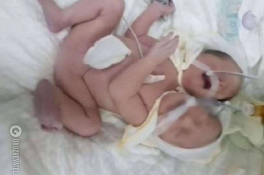 Photo of უკრაინაში დაბადებული სიამის ტყუპის ფოტო გავრცელდა